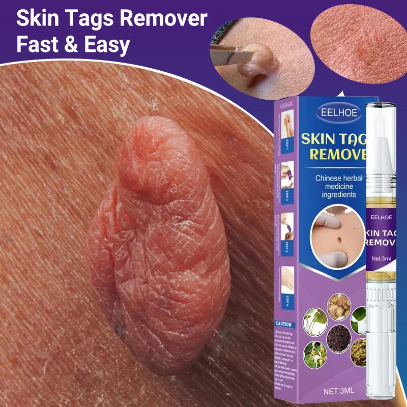 

New Warts Remover Essential Oil 7 Days Treatment Sarcoma Label Genital Papilloma Ointment Chinese Herbal Extract Beauty Health