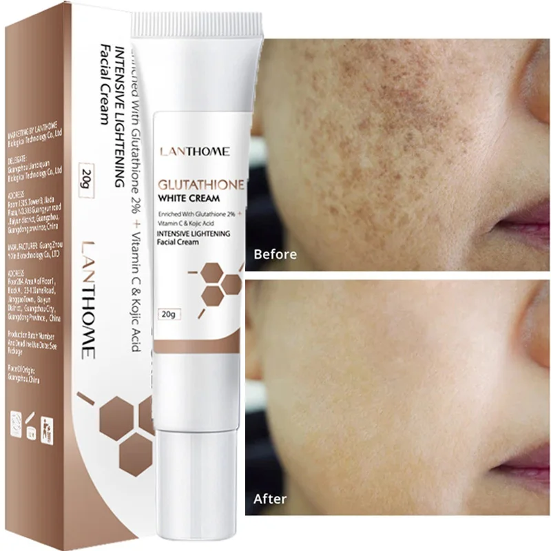 Effective Freckles Cream Whitening Remove Melasma Dark Acne Spot Melanin Moisturizing Brightening Face Skin Care Beauty 20g