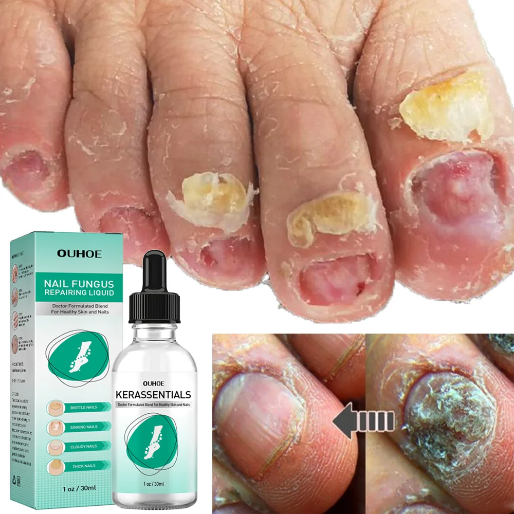 

Fungal Nail Treatment Serum Anti Infection Paronychia Onychomycosis Foot Nails Care Essence Foot Nail Fungus Removal Repair Gel