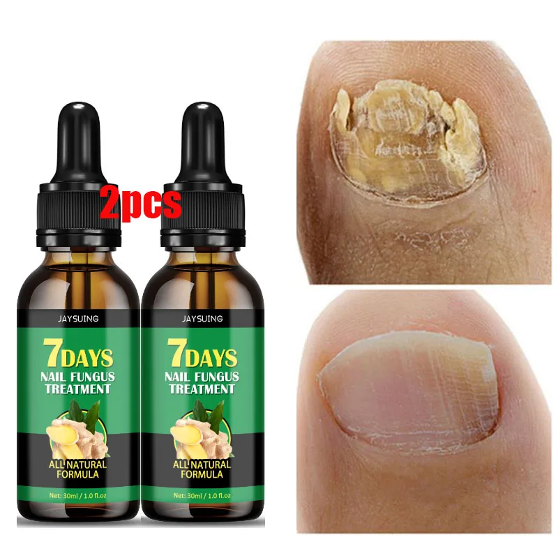 

2pcs Nail Fungal Treatment Essence 7 Days Ginger Anti Infection Paronychia Onychomycosis Foot Toe Nail Fungus Removal Gel Care M
