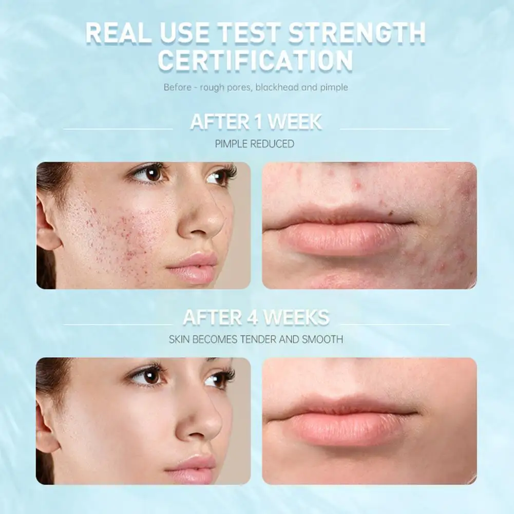 

15ml Salicylic Acid Acne Cream Facial Fight Black Spots Repair Pimple Remedy Marker Acne Cream Salicylic Acid G3P1