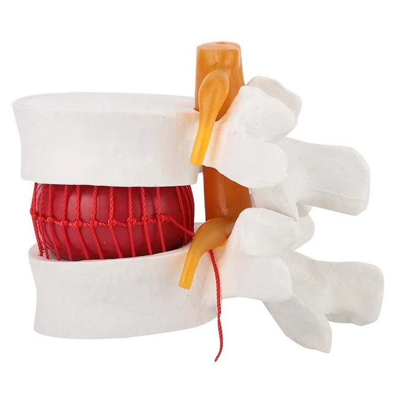 

1:1.5 Human Lumbar Disc Herniation Demonstration Model of Lumbar Vertebral Spine Model for Human Anatomy
