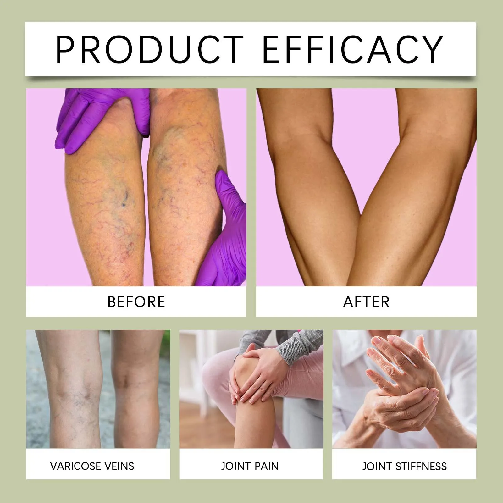 Крем для восстановления варикозного расширения вен эффективный крем лечения