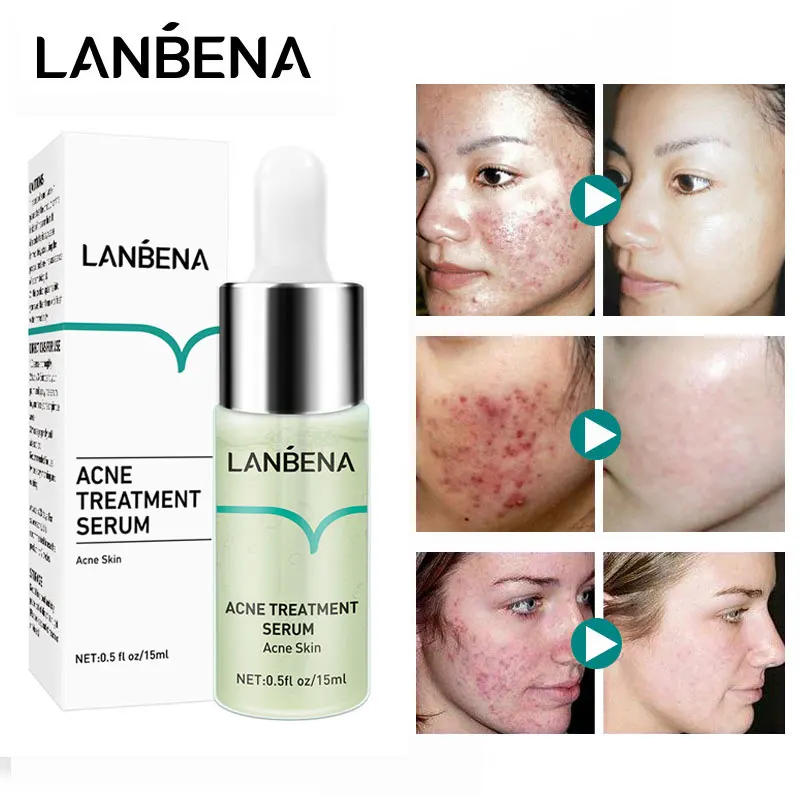 

Effective Acne Removal Serum Salicylic Acid Anti-Acne Face Essence Fade Acne Scar Shrink Pores Oil Control Moisturizing Care