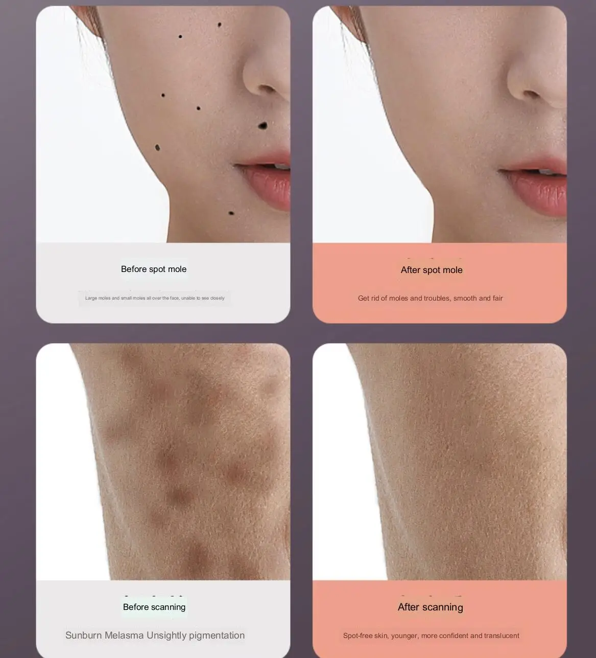 Плазменное Устройство Для Удаления Родинок Устранения Кожных Меток Лазерный