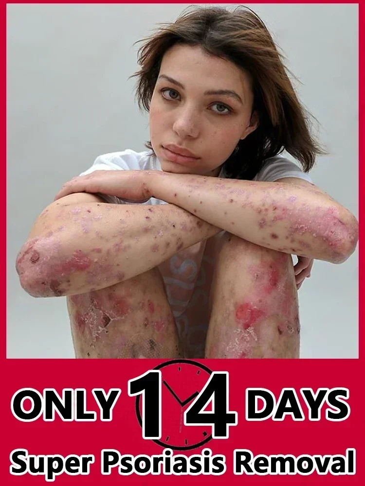 Крем от псориаза эффективное средство для удаления аналогичных продуктов