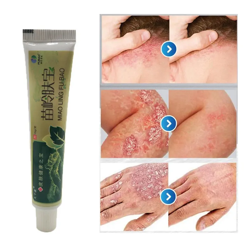 

Chinese Herb Medical Skin Care Psoriasis Ointment Skin DermatiTis Cream Atopic DermatiTis Eczema Cream