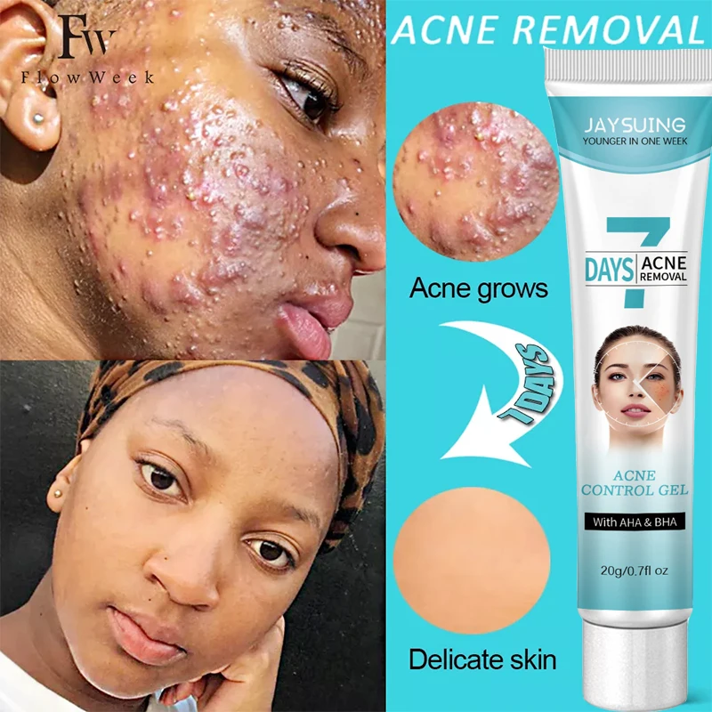 

Salicylic Acid Acne Removal Cream Effective Blackhead Treatment Repair Spots Scar Moisturizing Oil Control Shrink Pore Skin Care