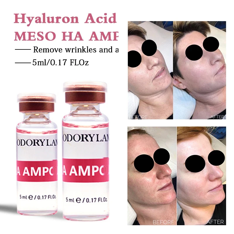 

Sdotter 5ml Cross-linked HA Hyaluronic Acid Ampoule Pure Micro Molecular Mesotherapy Collagen Hyaluronic Acid Wrinkles Whitening