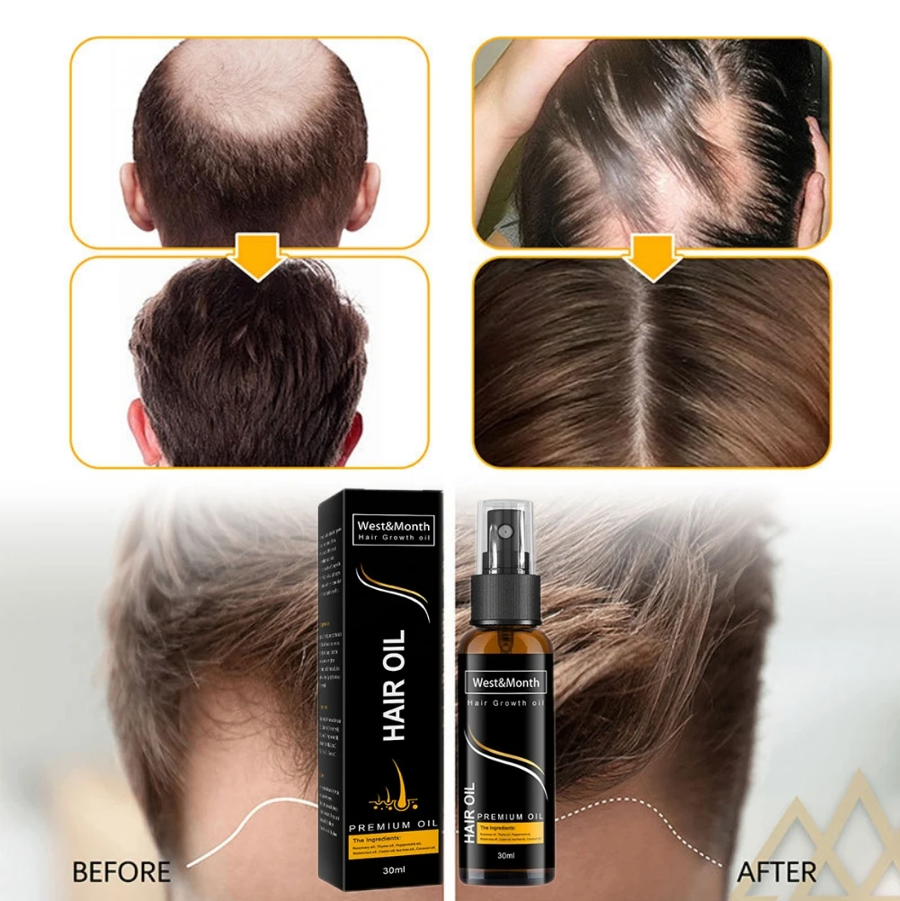 

30ml Hair Growth Essential Oil Dense Hair Growth Serum for Men/Women Hair Loss Treatment Scalp Care Germinal Regrowth Hair Oils