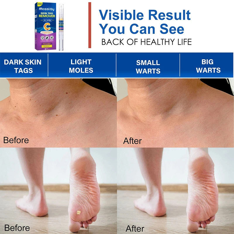 Рисунок 2 - Средство для удаления бородавок