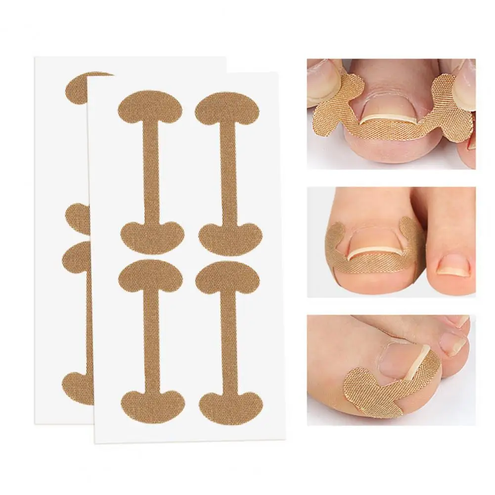 

1 Set Ingrown Toenail Corrector Universal Anti-pain No Glue Home Use Toenail Correction Kit Toenail Correction Patch
