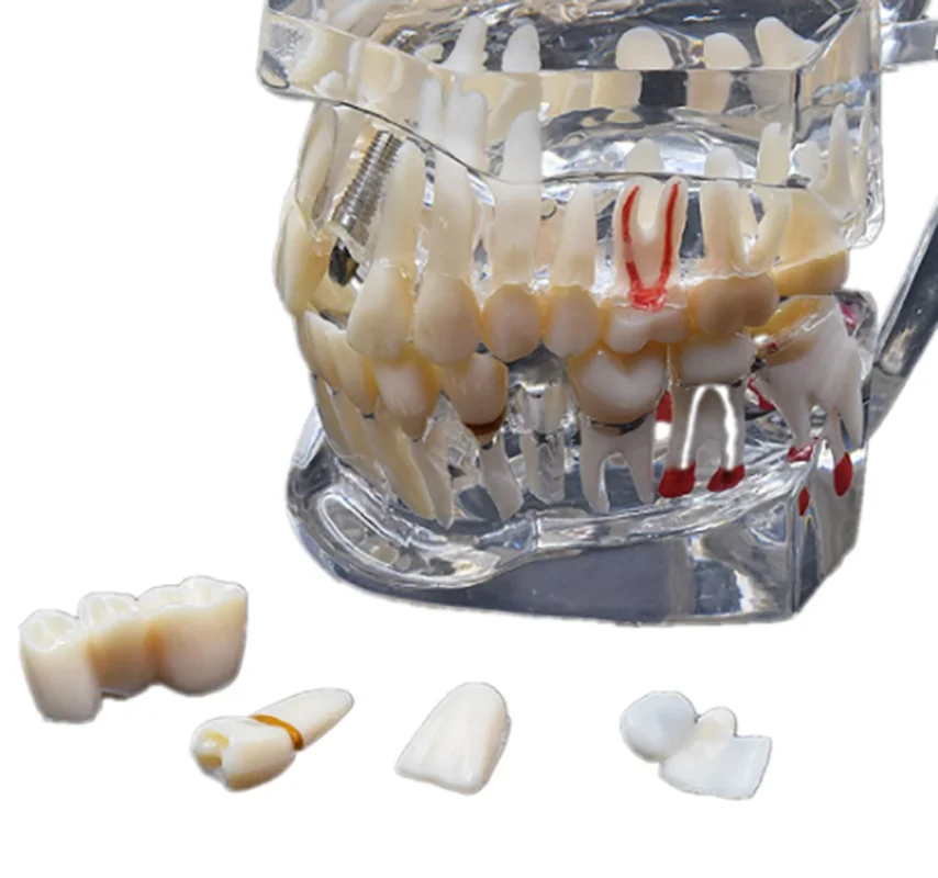 Мост для восстановления зубных имплантатов стоматологическое обучение