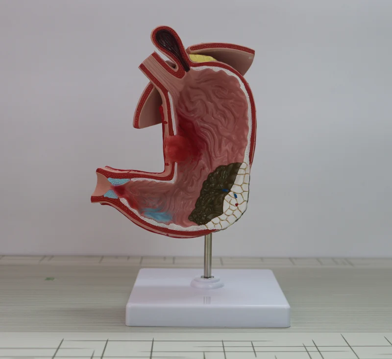 

Gastric Pathology Model