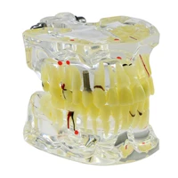 dental adult model typodont caries apical cyst impacted wisdom teeth pathologies teaching study periodontal demonstrating