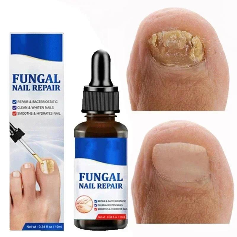 Антиинфекционный грибок для пальцев ног удаление рук и восстанавливающее масло