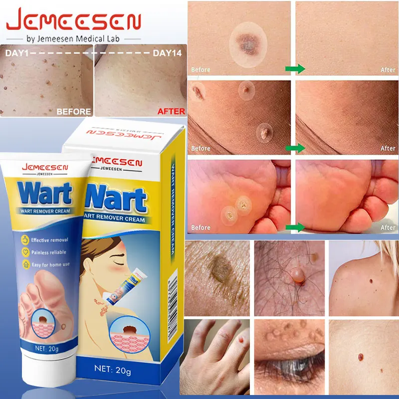 

Jemeesen Wart Remover Skin Tag Corrector Cream Skin Warts Remover Serum Freckle Face Wart Tag Corrector Removal Skin Health Care