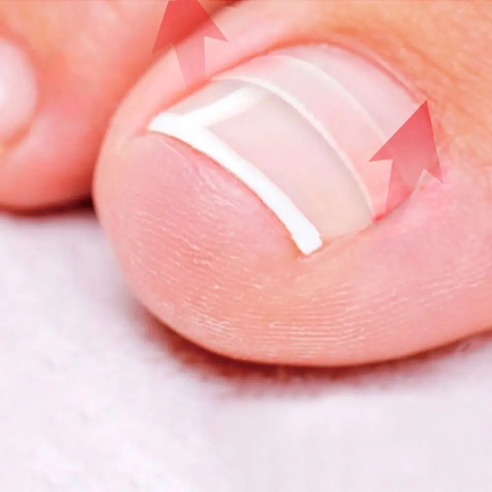 

10pcs Professional Toenail Correct Stickers Ingrown Toenail Tool Nail Repair Ingrown Toe Straightener Clip Paronychia Care Tools