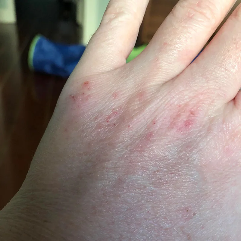 thumb