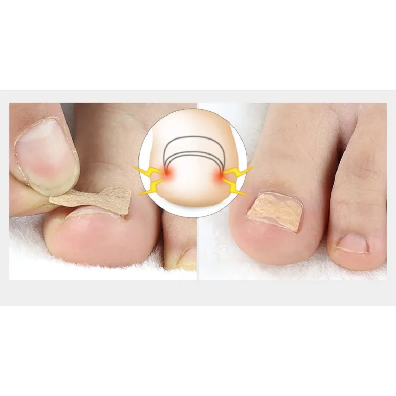 корректор вросшего ногтя. пластырь для коррекции вросшего ногтя. пластырь на ноготь на ноге. пластырь для коррекции вросшего ногтя. кератолитический пластырь для ногтей.