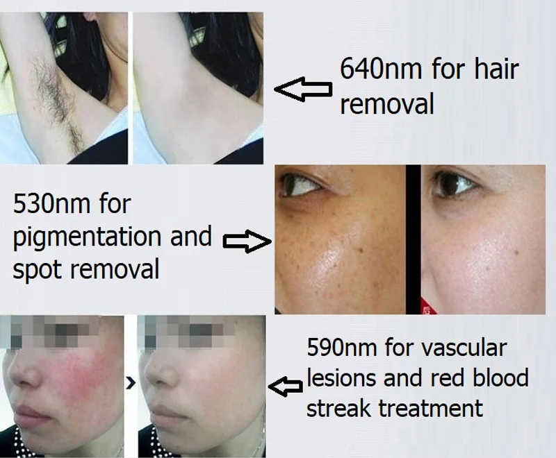 AU-S200B Auro для домашнего использования E-светильник OPT SHRr IPL RF устройство удаления