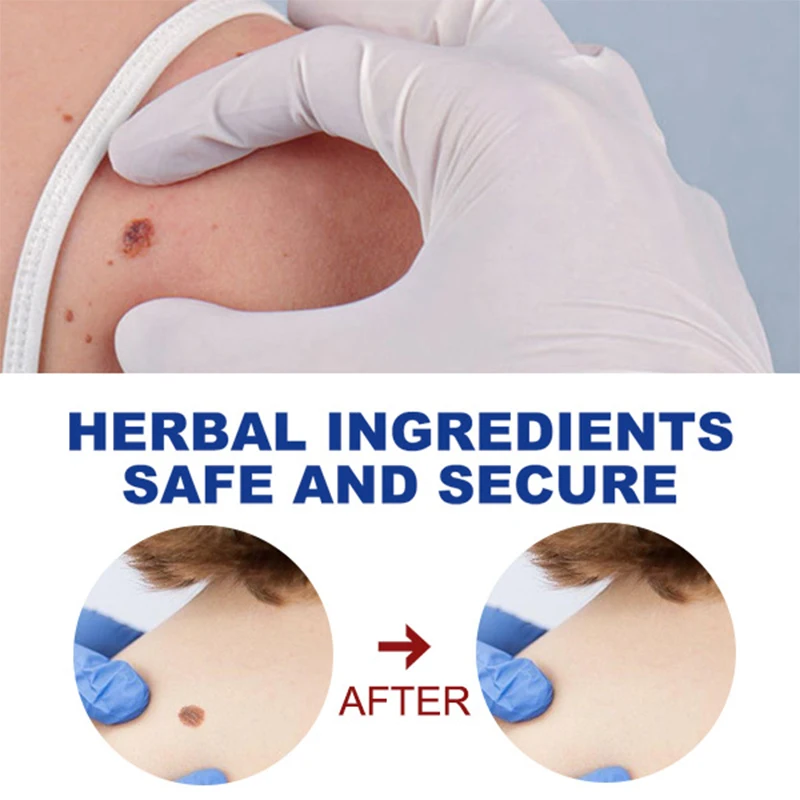 Средство для удаления бородавок с кожей средство от | Красота и здоровье