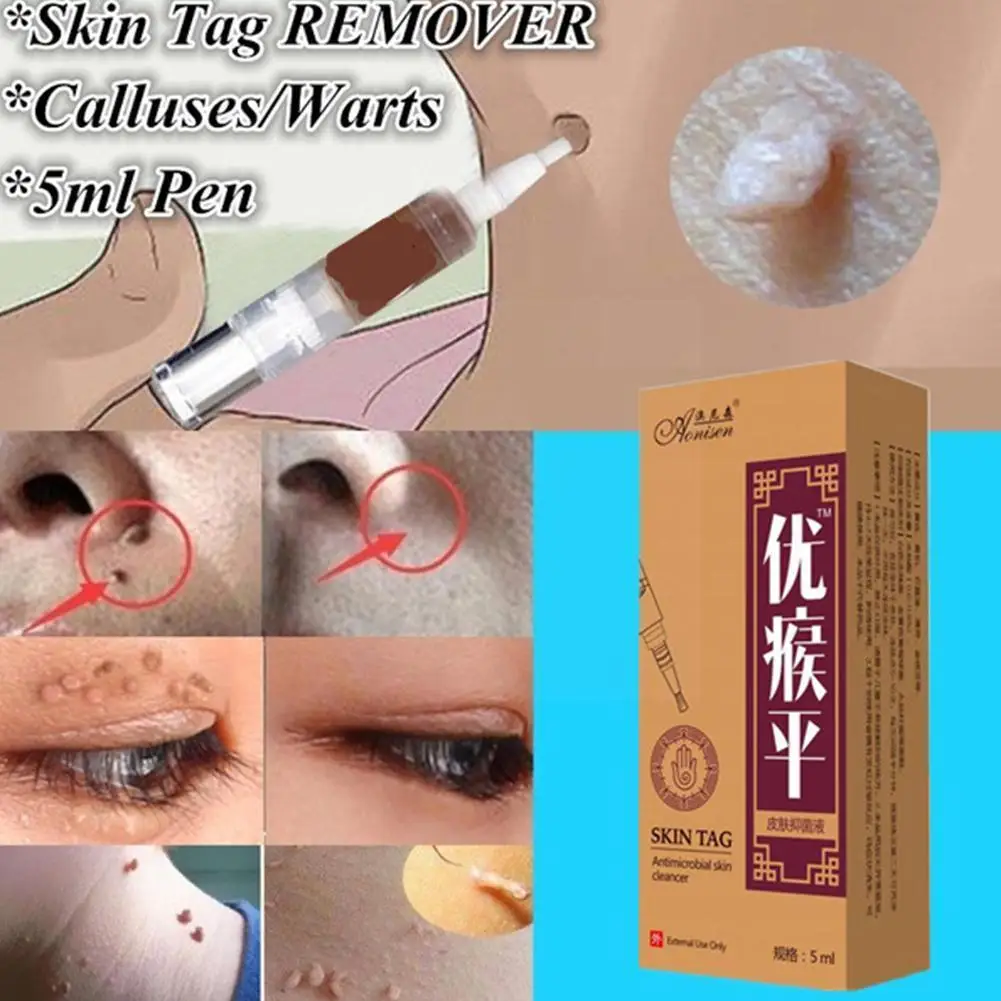 

Skin Tag Remover Pen 12 Hours Tu Kill Remover Medical Tag Remover Verruca Remover Wart Corn Wart Mole Liquid Genital Foot S E5j7