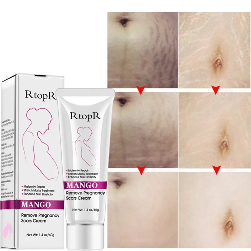 

Pregnancy Stretch Marks Cream Anti-Aging Cream Natural Gentle Non-irritating Remove Scars Acne,skin care,stretch marks removal
