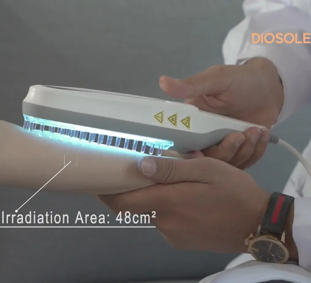 CE функция таймера узкий диапазон uvb фототерапия 311 нм лампа для vitiligo топового