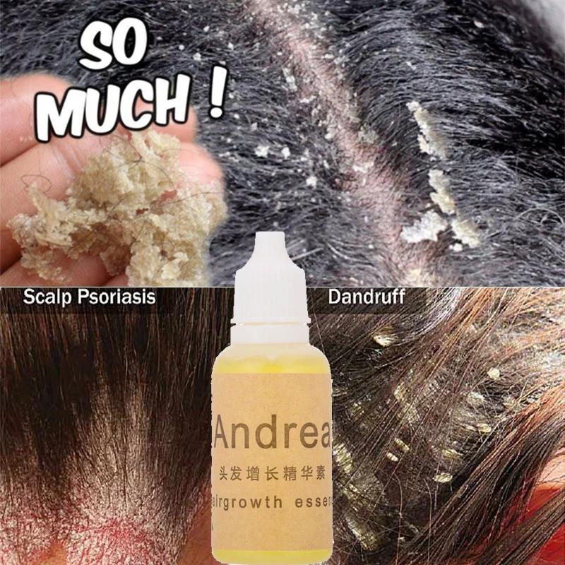 

20ml Natural Anti Dandruff Essential Oils Fast Get Rid of Anti Dandruff Hair Loss Scalp Cleaning Dandruff Repair Health Care