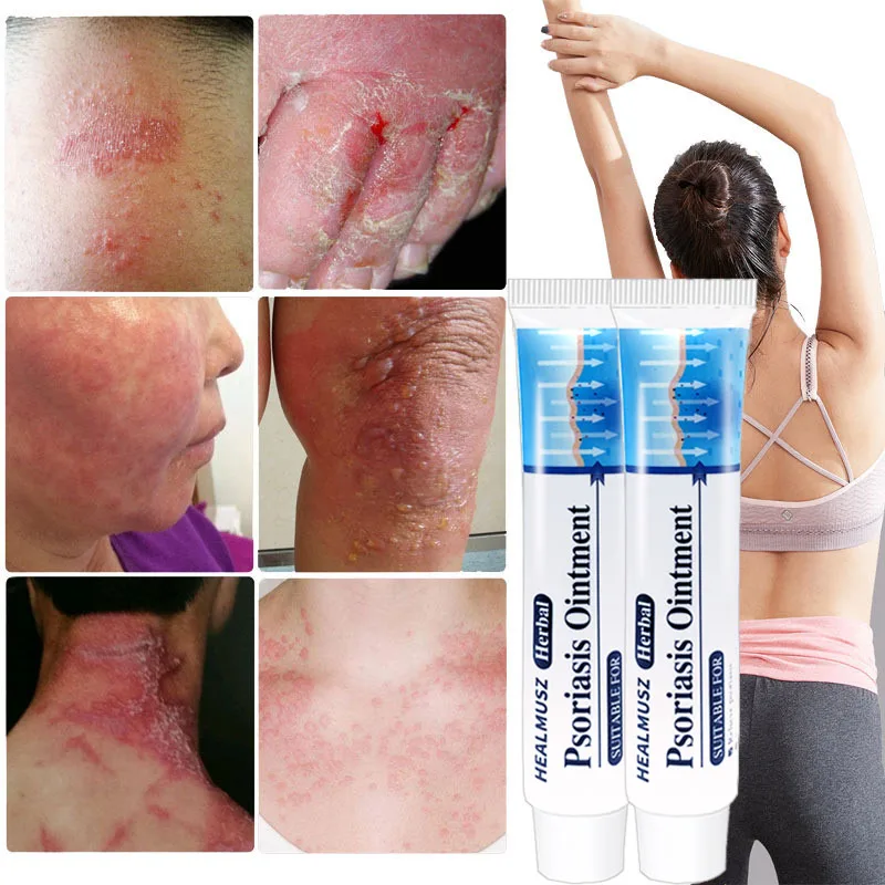 Мазь при псориазе экземе, 20/40 шт., 20 г