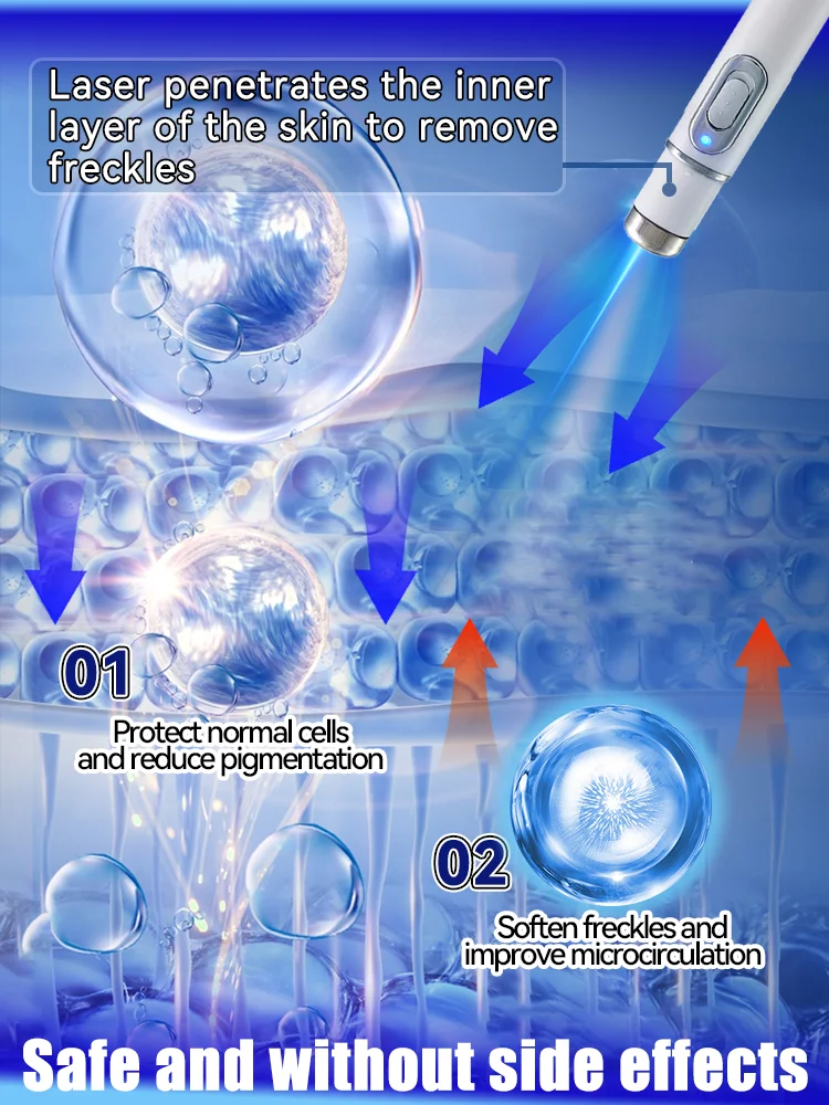 Лазерный быстрый ремонт веснушек на лице