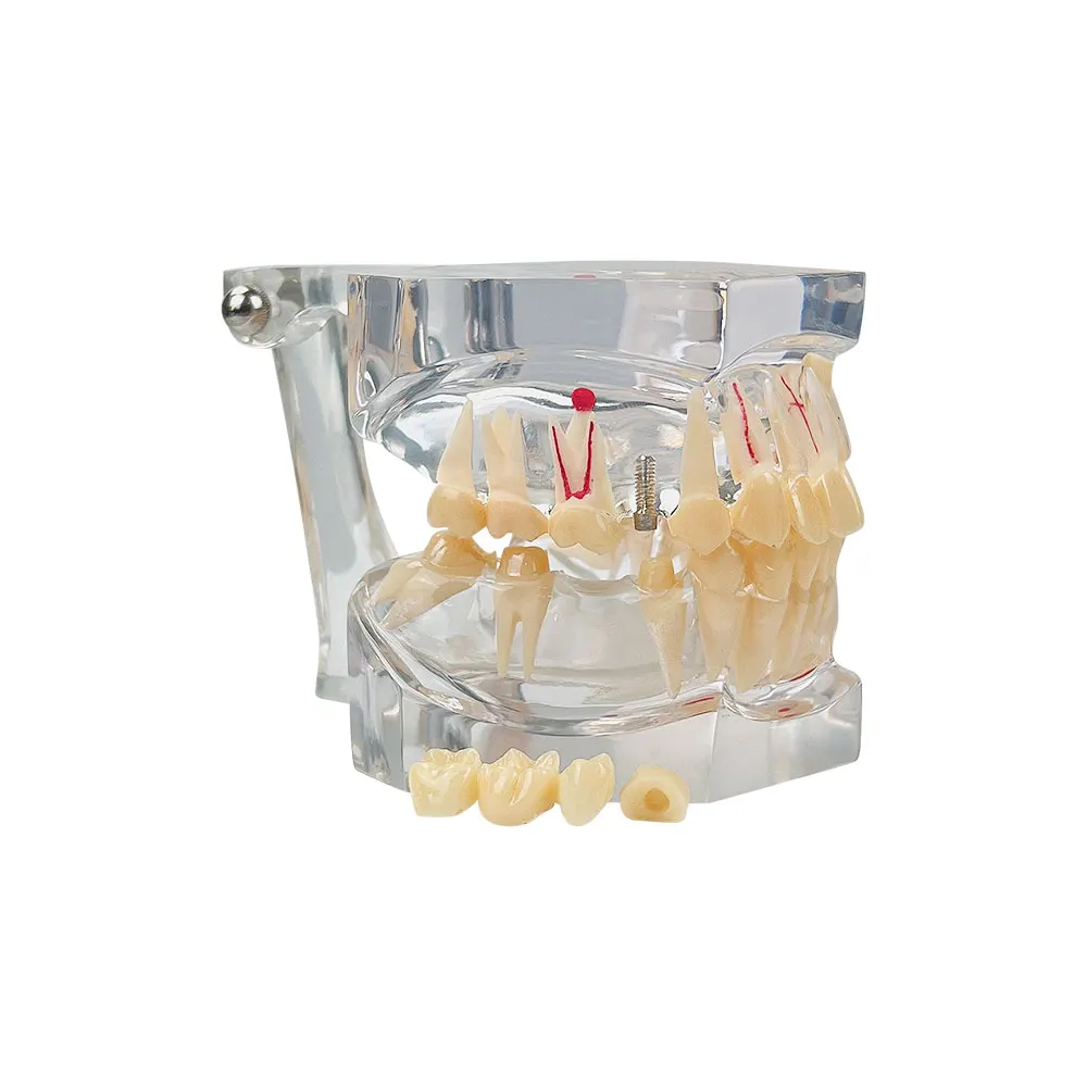 Модель зубов для стоматологической патологии 2 5 раза стоматология обучающая