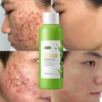 green tea oil control acne treatment face lotion hyaluronic acid shrink pores moisturizing nourish brightening beauty skin care