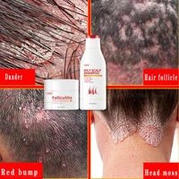 2pcs natural plant mites shampoo anti dandruff anti itching shampoo scalp treatment dermatitis eczema herbal shampoo hair care