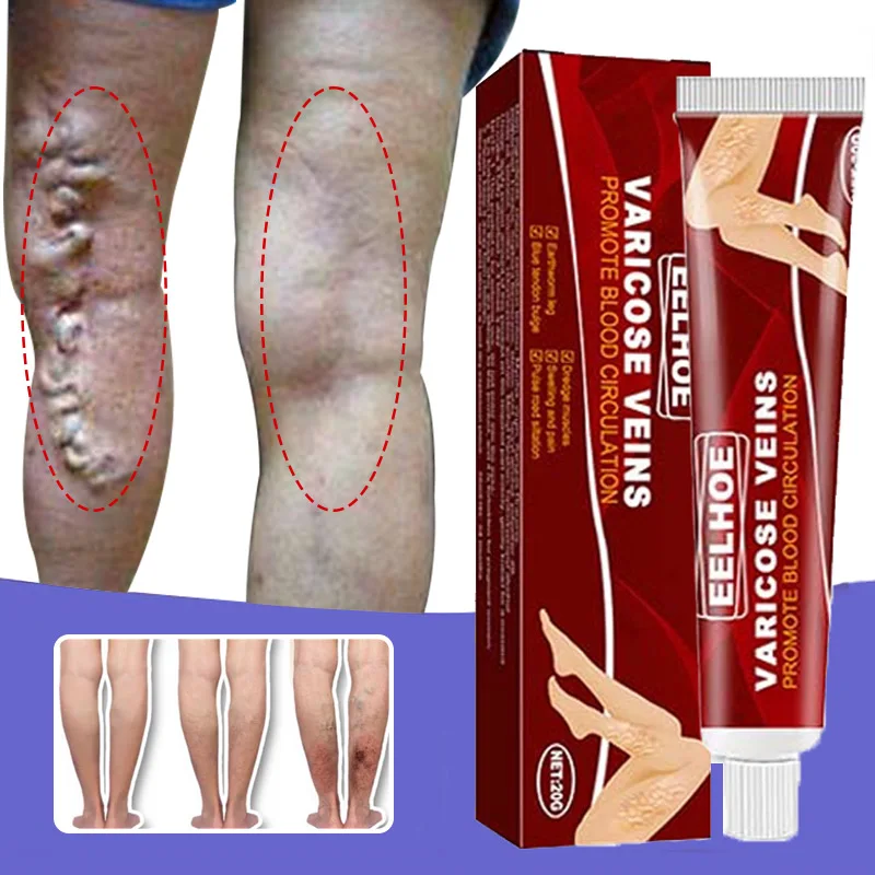 

Effective Herbal Varicose Veins Relief Cream Vasculitis Phlebitis Spider Pain Relief Ointment Herb Plaster Beauty Body Care 20g