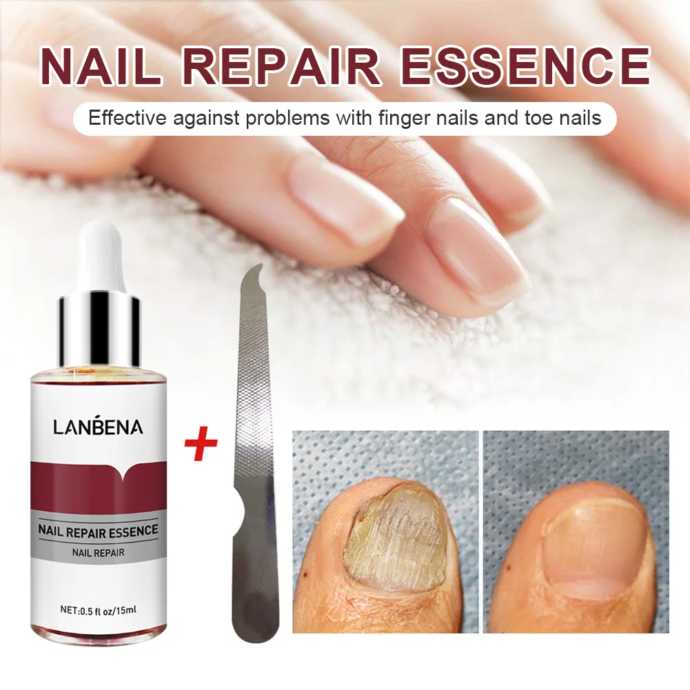 

Fast Repair Nail Repair Essence Nail Fungus Treatment Serum Onychomycosis Cracked Damaged Nails Repair for Finger Nails Toenails