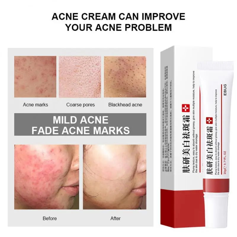 Whitening Freckle Cream Effective Remove Dark Spots Anti Freckle Cream Fade Pigmentation Melasma Brighten Cream