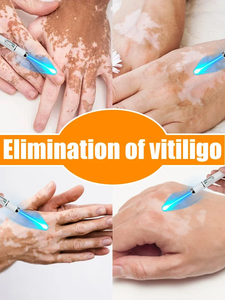 Vitiligo быстро улучшает белые пятна