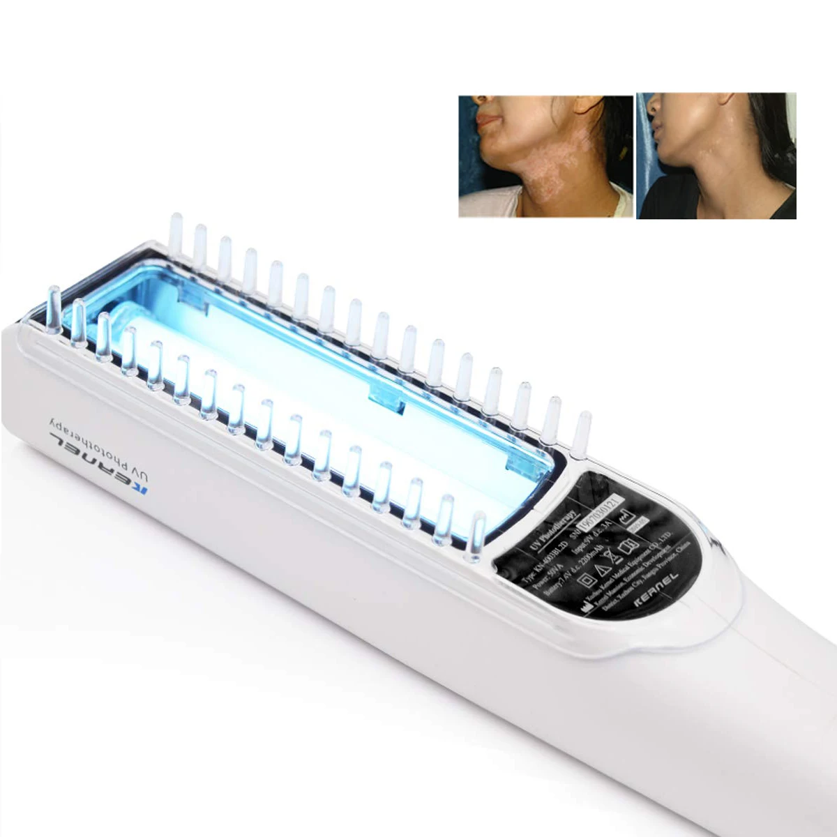 лампа philips от псориаза. облучатель ультрафиолетовый ультрамиг. Kn-4003bl. лампы для домашнего лечения псориаза. облучатель филипс от псориаза.