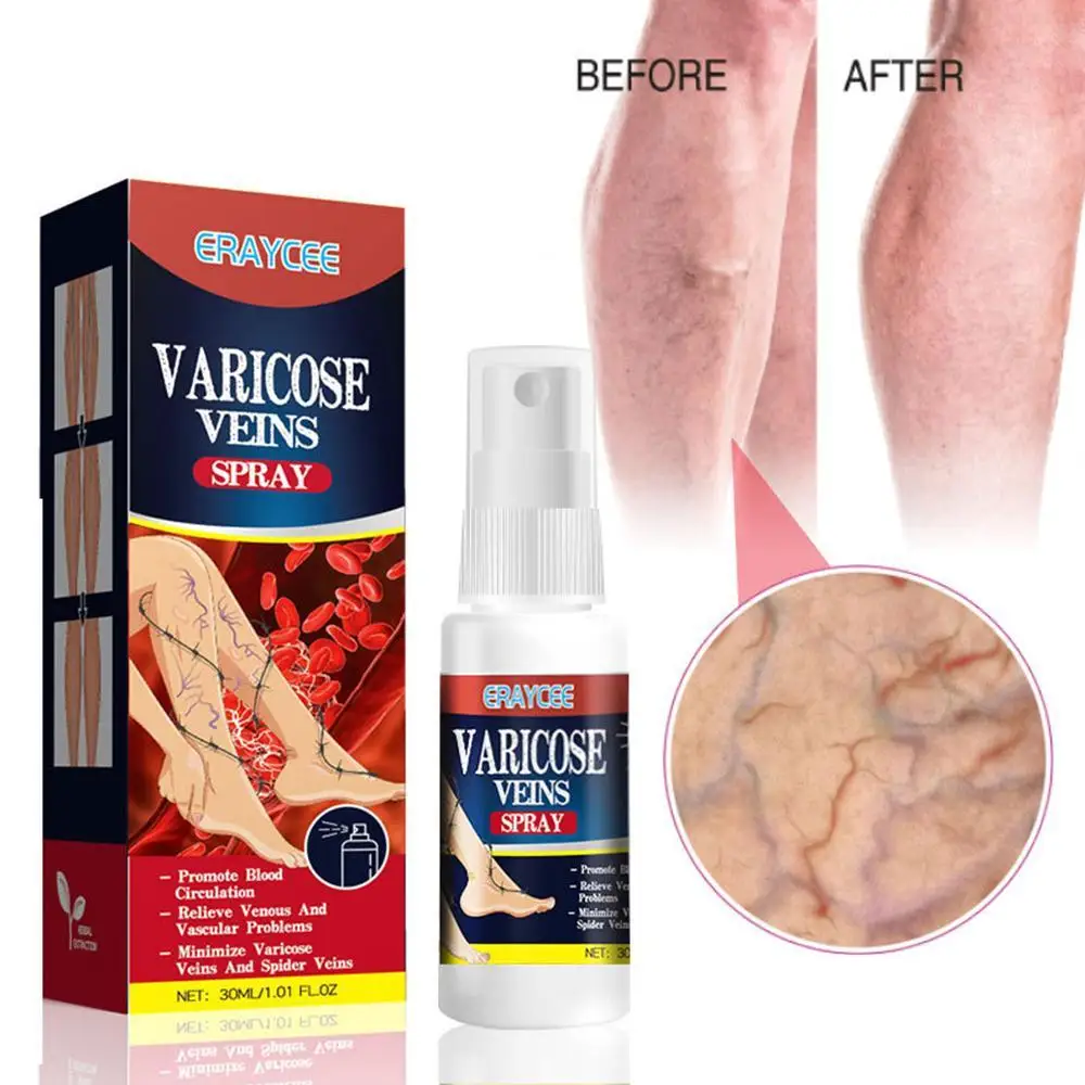 

Effective Herbal Varicose Vein Relief Cream Relieve Leg Vasculitis Phlebitis Spider Pain Swelling Treatment