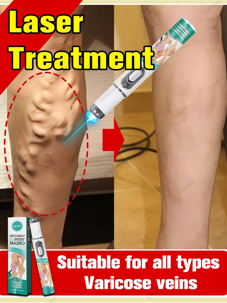 Крем-лазер Varicosse