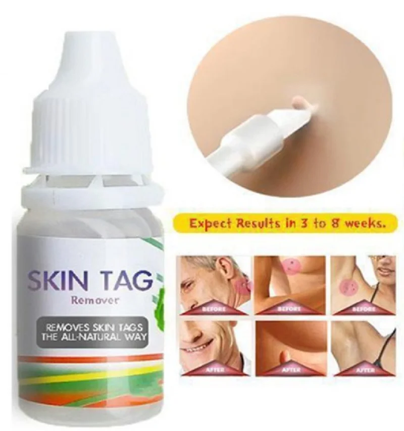 

Skin Tag Remover 12 hours Tu kill Medical Tu kill Remover Skin Tag Mole & Genital Wart Remover Foot Corn Removal 10ml