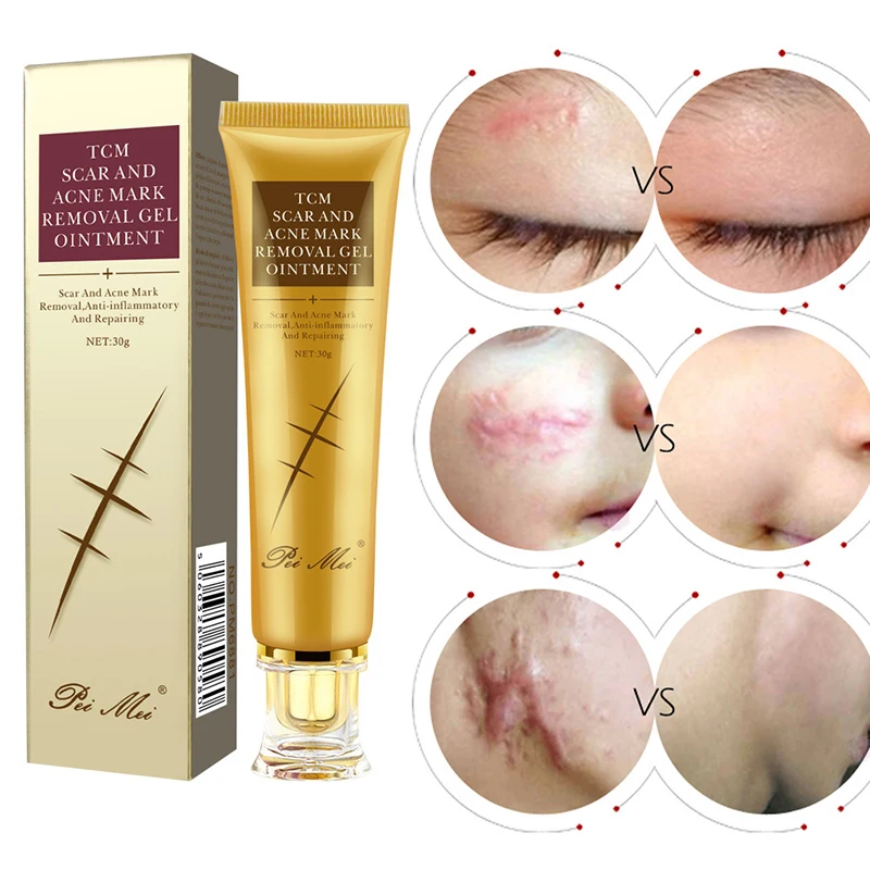 

Acne Scar Removal Cream Skin Care Stretch Marks Treatment Pimples Spots Repair Gel Whitening Moisturizer Smooth Beauty Cosmetics