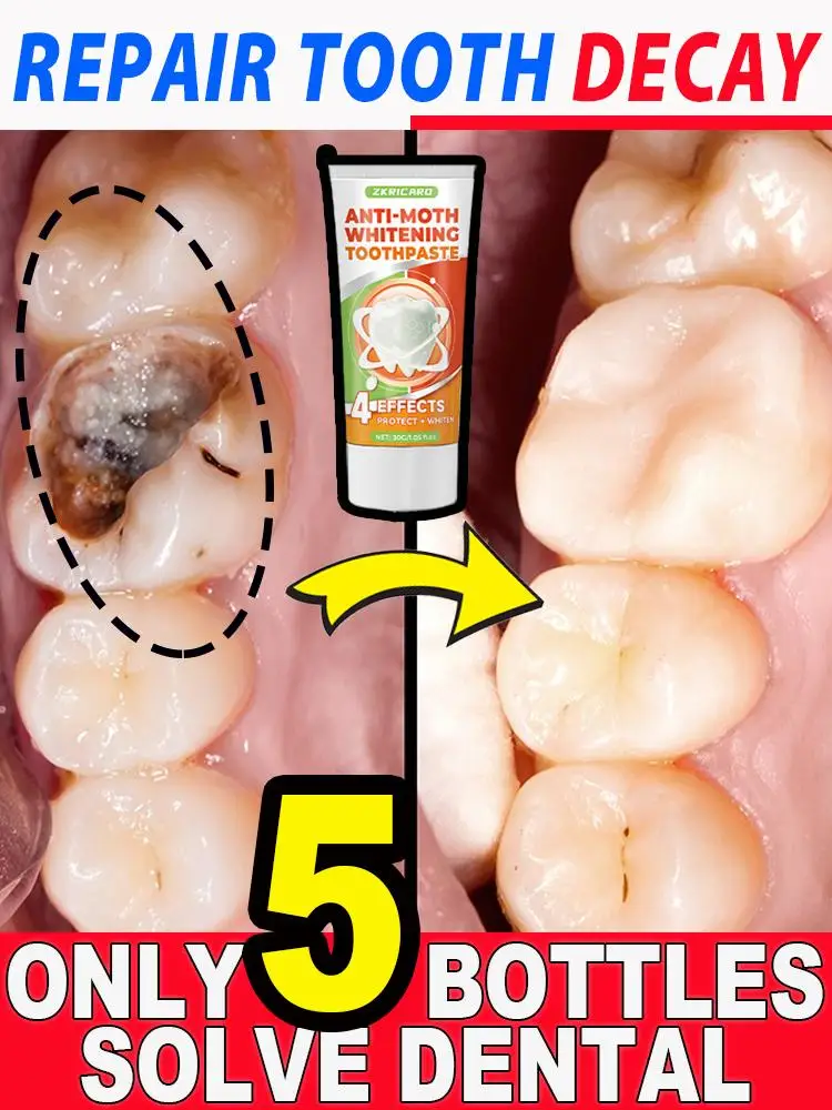 5 шт. кариес для чистки зубов 30 г