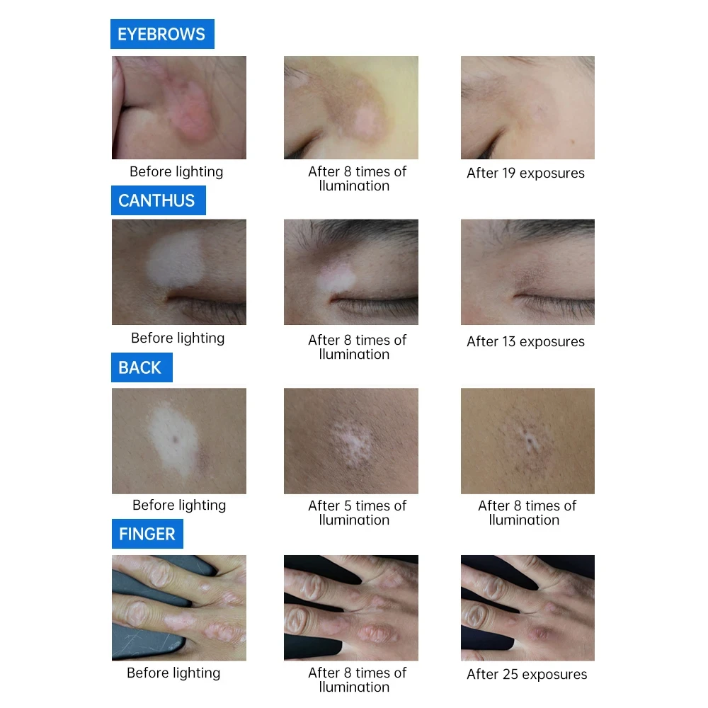 Uvb лампа vitiligo Оборудование для физиотерапии компактная фототерапии медицинская