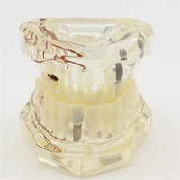 1pcs dental teaching teeth model with nerve implanted transparent pathological repair teaching demonstration model dentistry