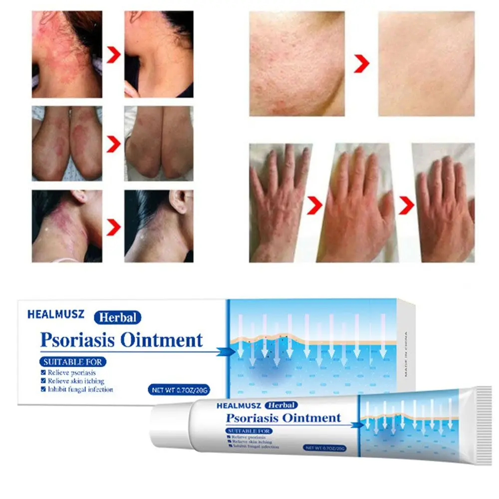 

Лечение травяной экземы, сыпь от зуда