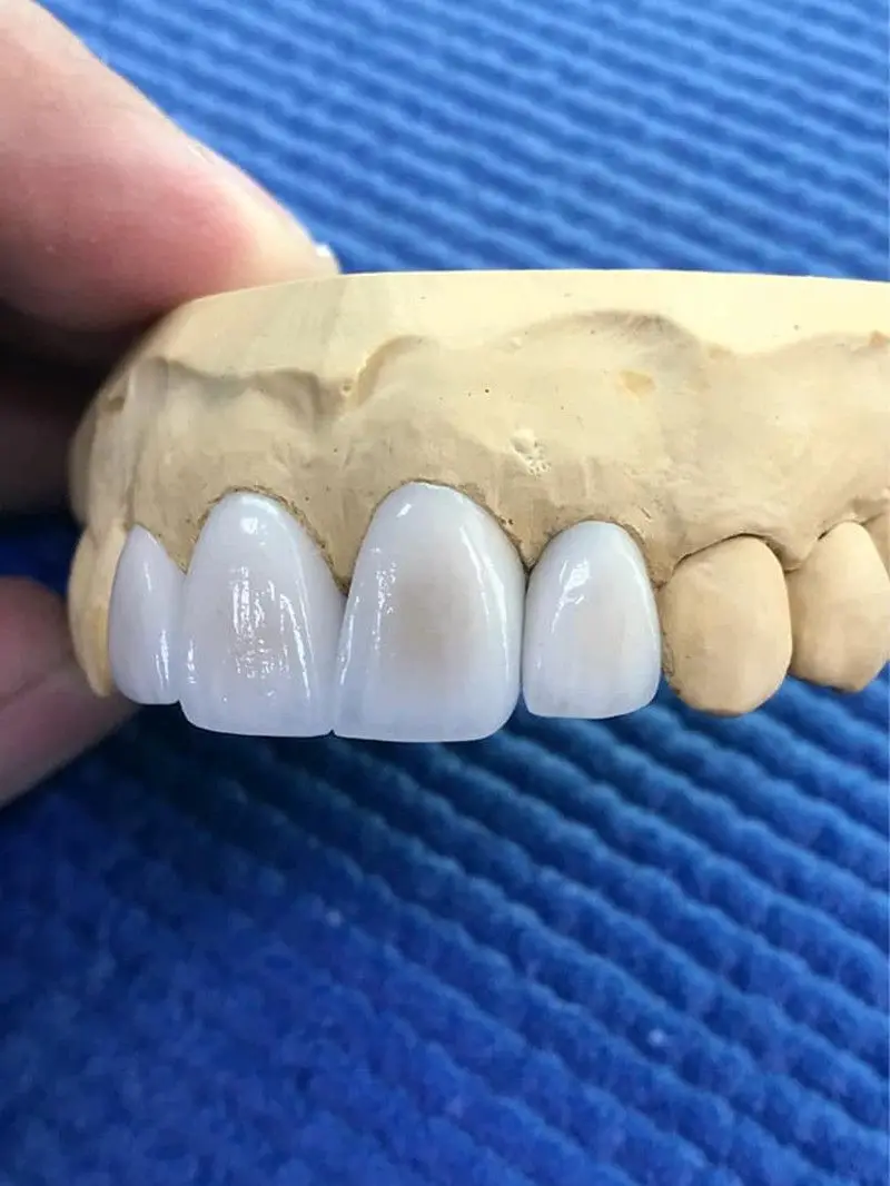 E.max Press Lithium Disilicate Glass-ceramic For Dental Press System