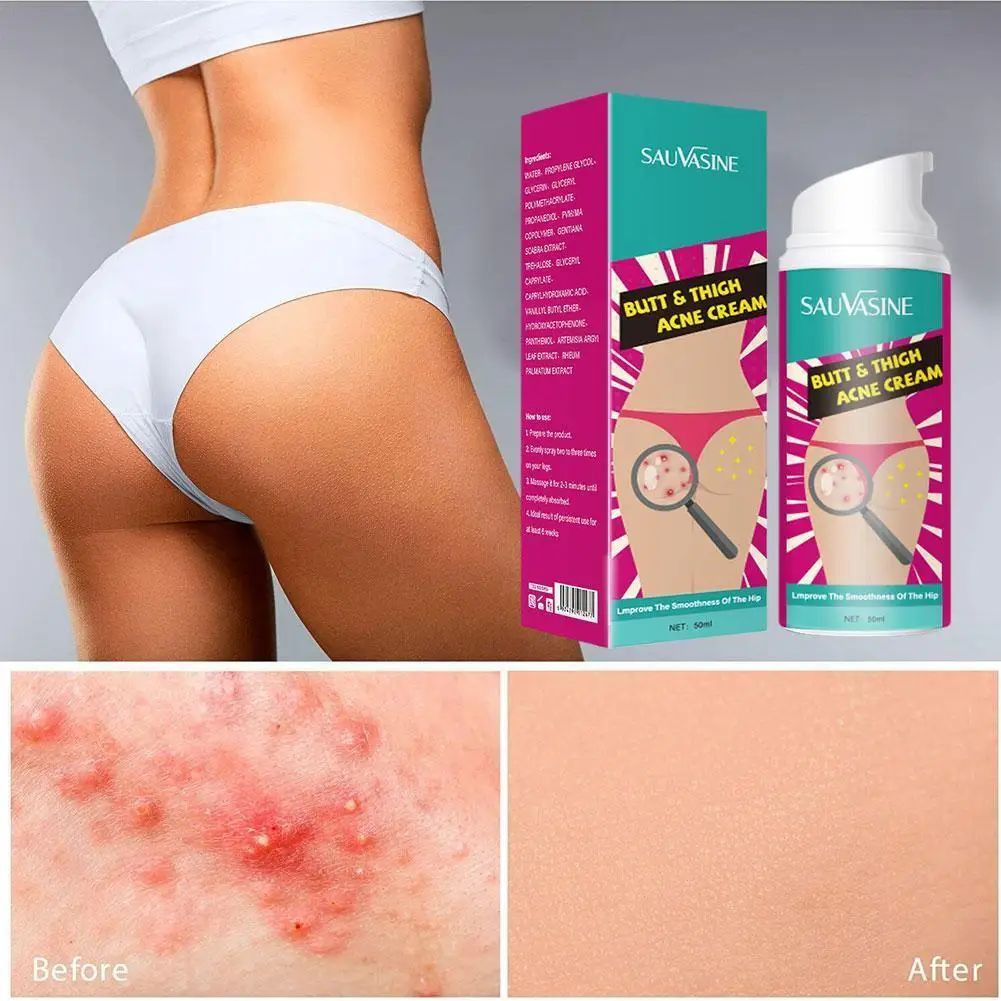 

Acne Face Cream Herbal Pimple Scar Removal Shrink Pore Oil Oil Acne Control Scars Treatment Pores Anti Face Control Shrink A4D6